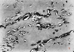 F,71y. | silver pigment in epidermal stratum corneum